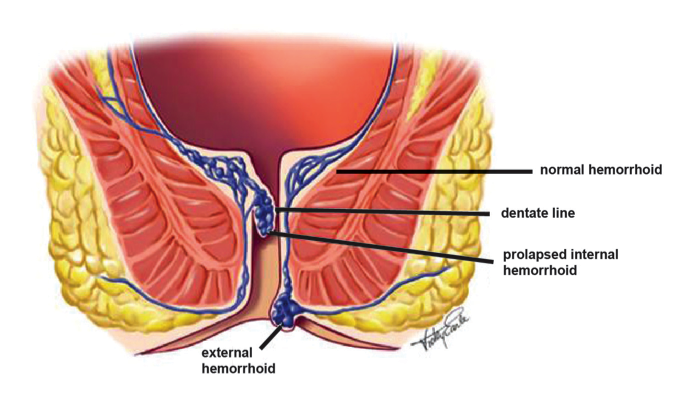 hemorrhoid-external-internal-picture1